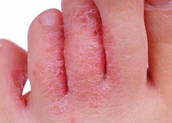 Foto von Fußpilz befallenen Zehen. Typisch ist die rote, sich schuppende Haut. Eine Behandlung ist unbedingt erforderlich.